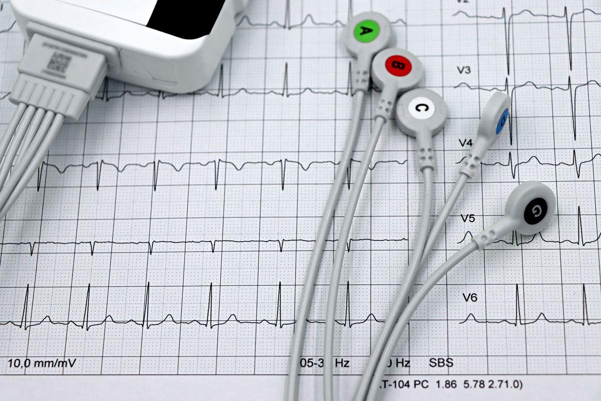 Eletrodos de ECG coloridos conectados sobre um traçado impresso de eletrocardiograma